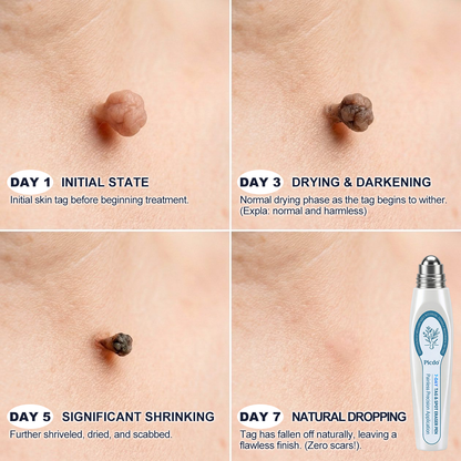 𝐏i𝐜𝐝o® 7-𝐷𝑎𝑦 𝗧𝐚𝐠 & 𝗦𝗽𝐨𝐭 𝐄𝐫𝒂𝒔𝒆𝒓💪(Zero Pain, Zero 𝐒𝐜𝐚𝒓𝒔 Rollerball)