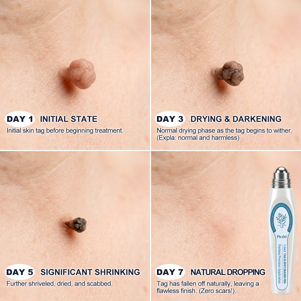 😁𝐏i𝐜𝐝o® 7-𝐷𝑎𝑦 𝗧𝐚𝐠 & 𝗦𝗽𝐨𝐭 𝐄𝐫𝒂𝒔𝒆𝒓(Zero Pain, Zero 𝐒𝐜𝐚𝒓𝒔 Rollerball)